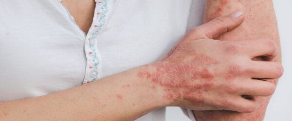 Hypnosis for Psoriasis | To Help With This Dreaded Skin Condition