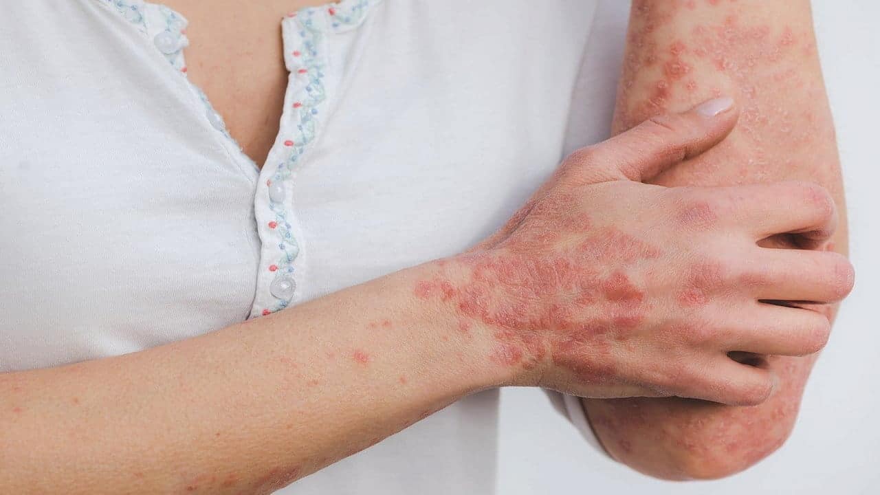 a female person with psoriasis